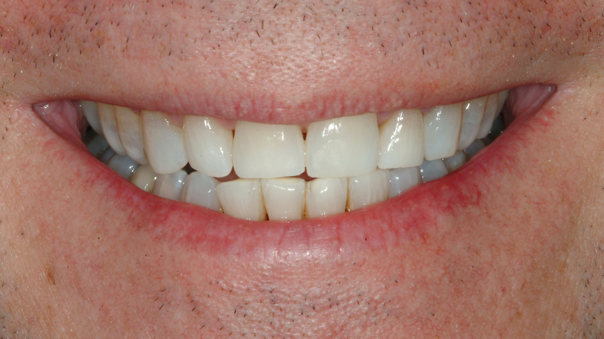 Professional Dentist Teeth Whitening Dental365 professional-dentist-teeth-whitening-dental365